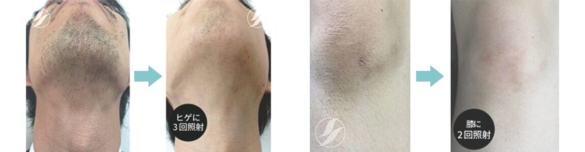 メンズ脱毛