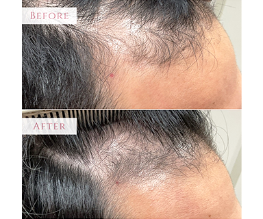 薄毛ビフォーアフター