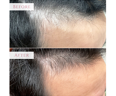 薄毛ビフォーアフター