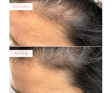 薄毛ビフォーアフター