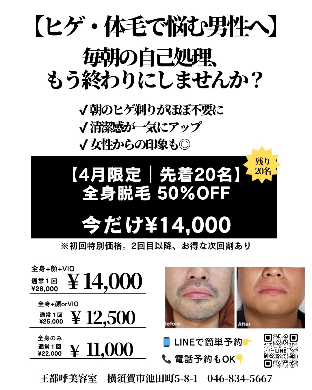 メンズ全身脱毛